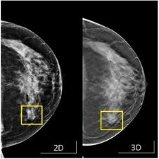 Mammogram Image